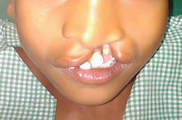 Cleft Lip And Palate Surgery