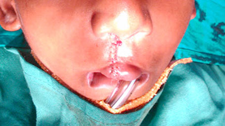 Cleft Lip And Palate Surgery