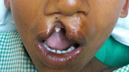 Cleft Lip And Palate Surgery